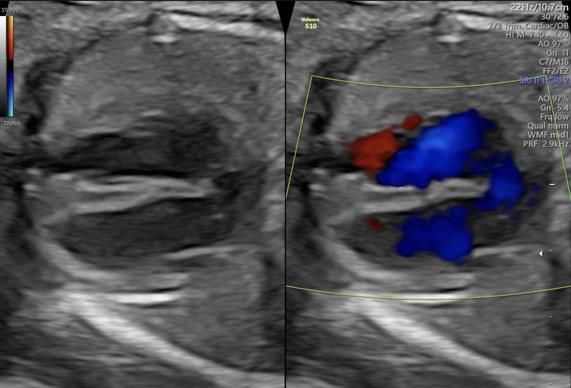 Ecocardiografía Fetal