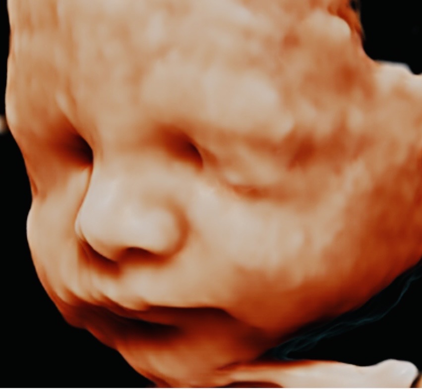 Ecografía de Crecimiento 7D Doppler