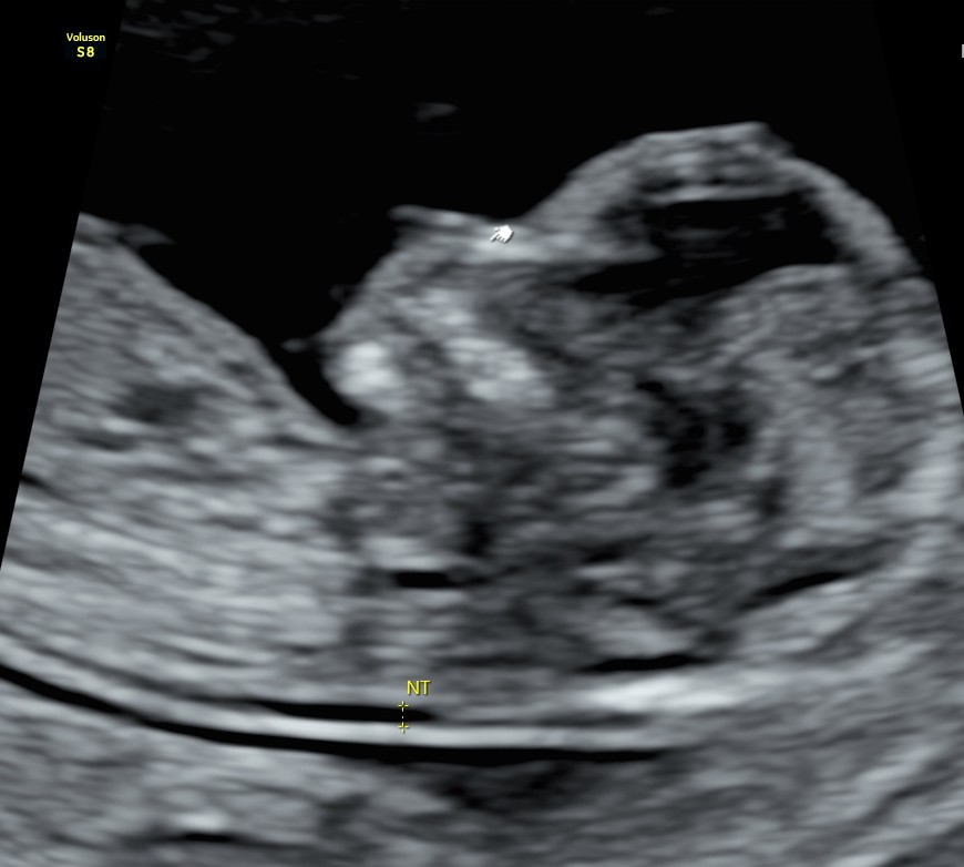 Ecografía Genética Gemelar