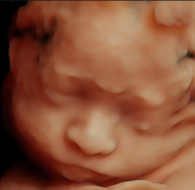 Ecografía Morfológica Gemelar