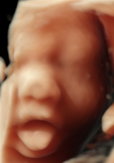 Ecografía Morfológica