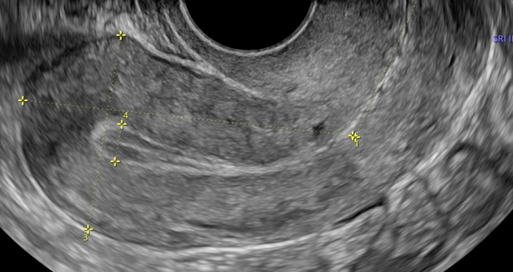 Ecografía Transvaginal
