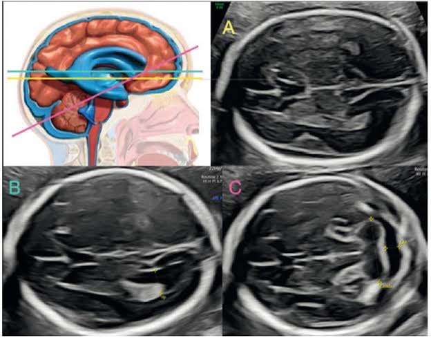 Neurosonografía Fetal